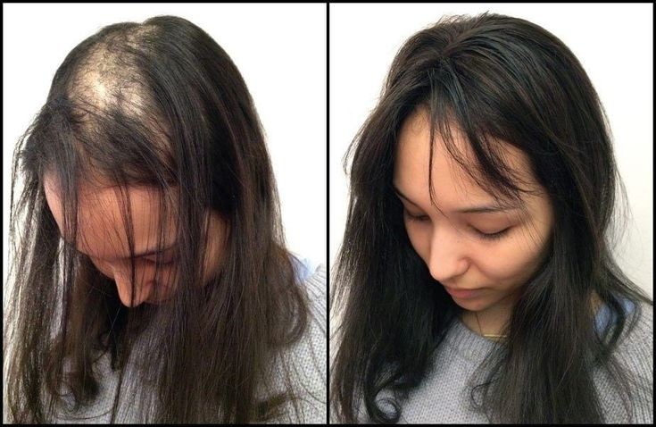 Medical Wigs For Alopecia and Cancer Patients