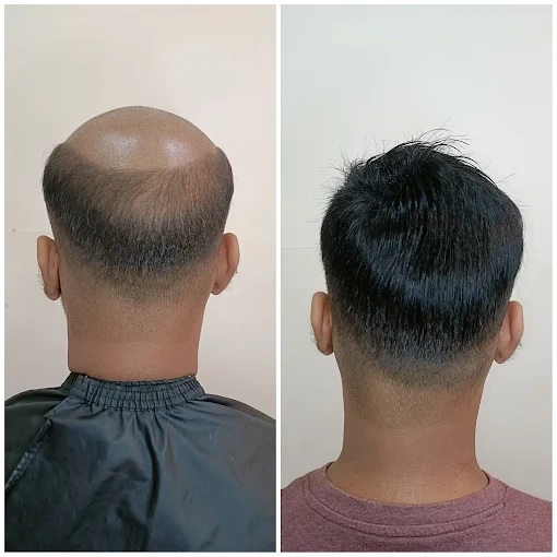 Hair Patch