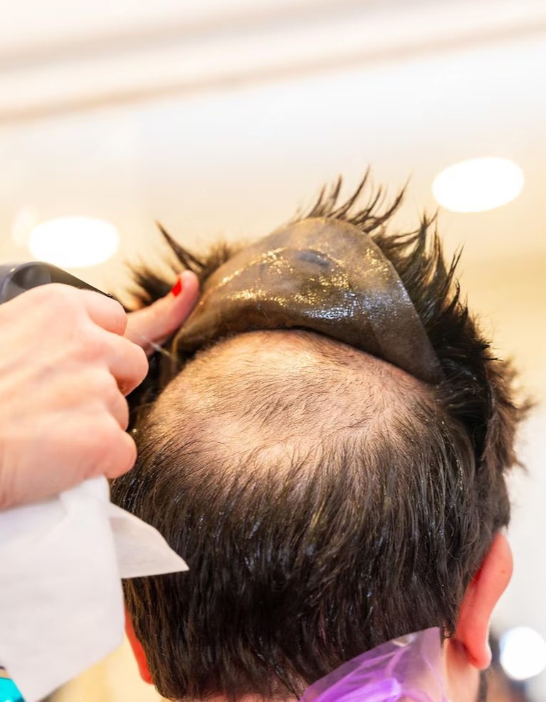 Best Hair Fixing in Jaipur