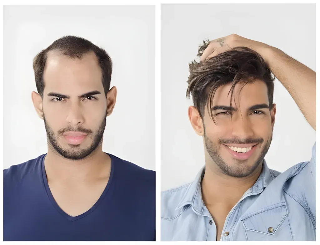 Best Hair Fixing in Jaipur